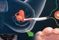 (广州试管得多少钱？广州三甲医院做试管费用大概多少钱？